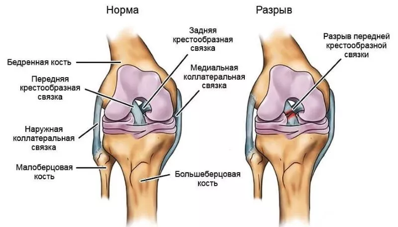 Что значит «порвать кресты» и как это лечат